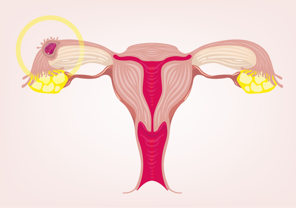 Management of Pregnancy of Unknown Location (PUL)